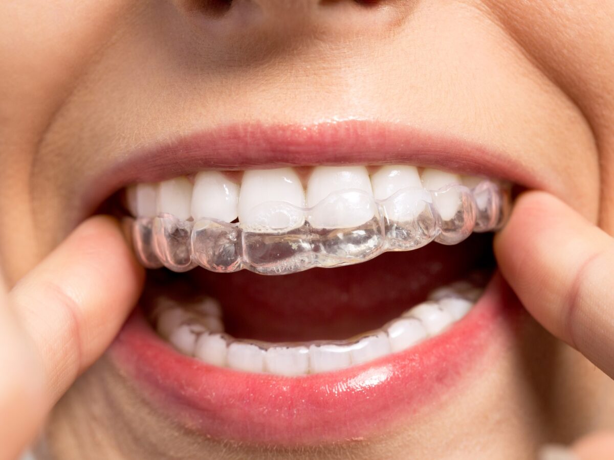 What I Wish I’d Known Before Starting Invisalign: A Personal Guide