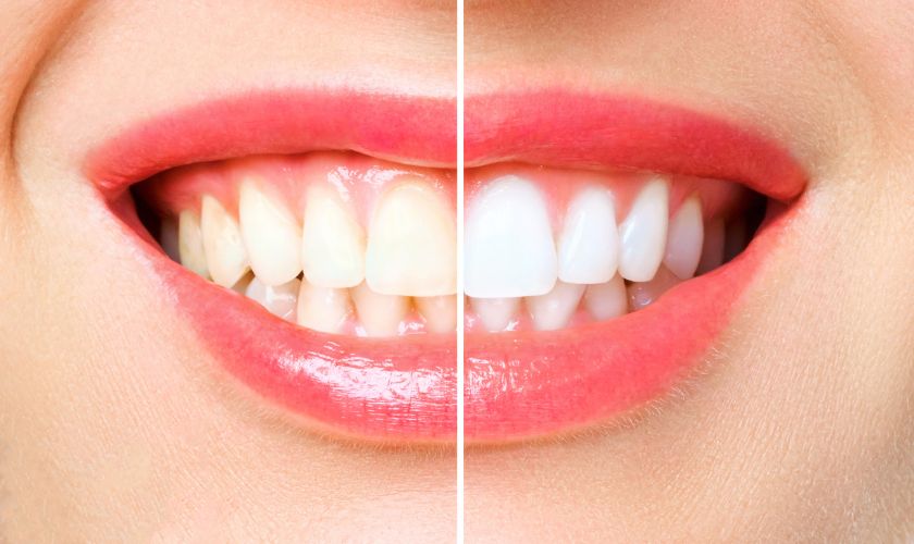 Myths and Truths About Teeth Whitening