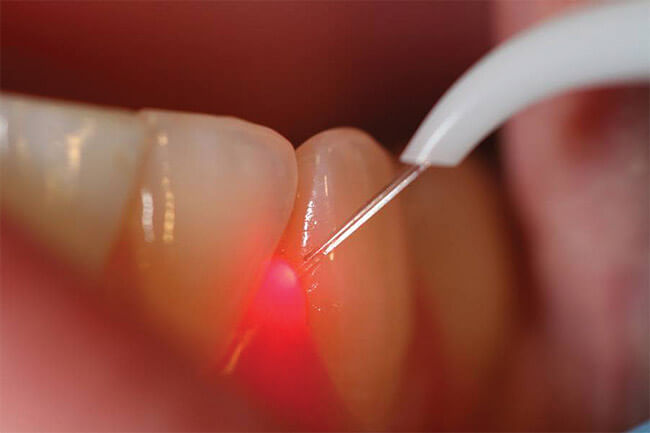 Discover the Benefits of Laser Dentistry with Dr. Monica Morgan