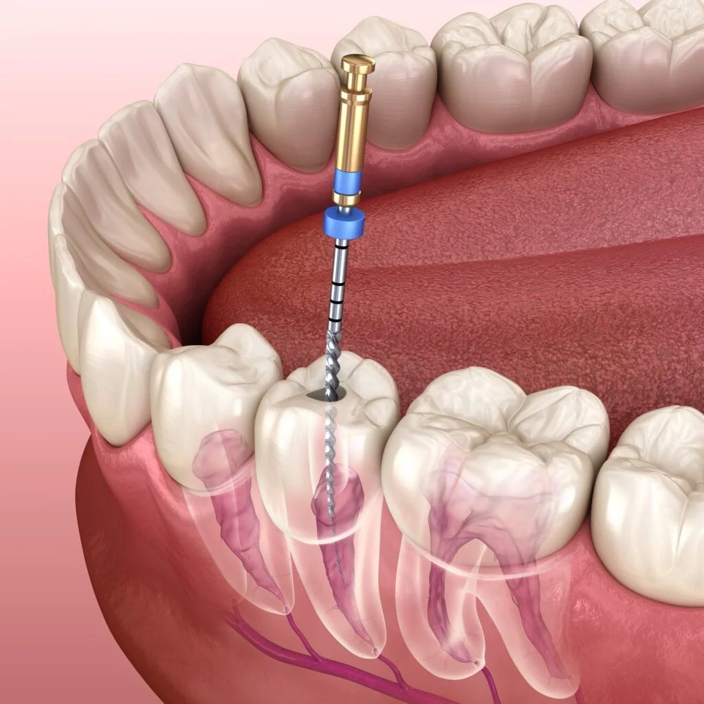 Understanding Root Canals: Why They Are Essential for Your Dental Health