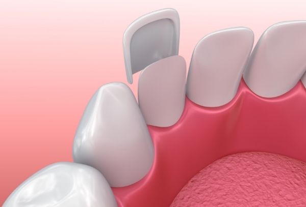 What to Do If Your Veneer or Crown Breaks: A Quick Guide